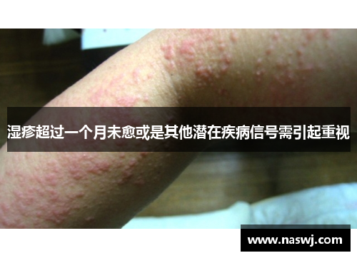湿疹超过一个月未愈或是其他潜在疾病信号需引起重视